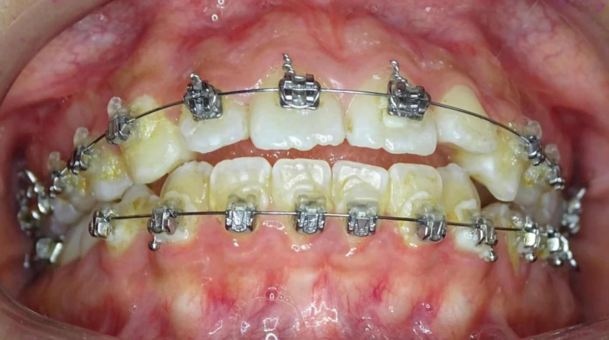 Dientes con brackets metálicos durante el tratamiento